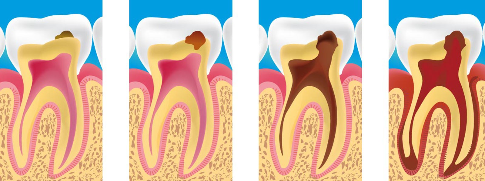 Quando a cárie atinge do esmalte, os dentes podem se tornar sensíveis. 
Leia mais