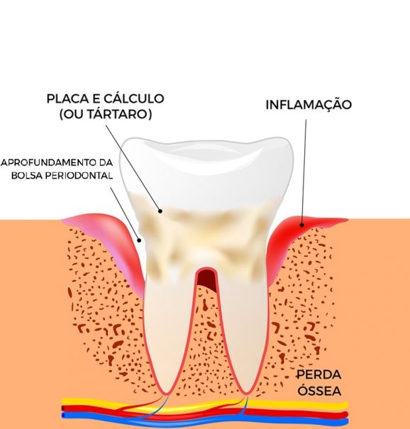 Essa vilã normalmente surge por conta do acúmulo de tártaro que se forma a partir das placas bacterianas, reflexo de uma higiene bucal incorreta e da ausência nas visitas ao dentista. Por isso é tão importante aprender a utilizar todas as ferramentas para combater a periodontite, como a escova e o fio dental. Ir ao odontologista é um compromisso que não pode sair da sua agenda. Marque uma consulta regularmente, de acordo com sua saúde bucal.